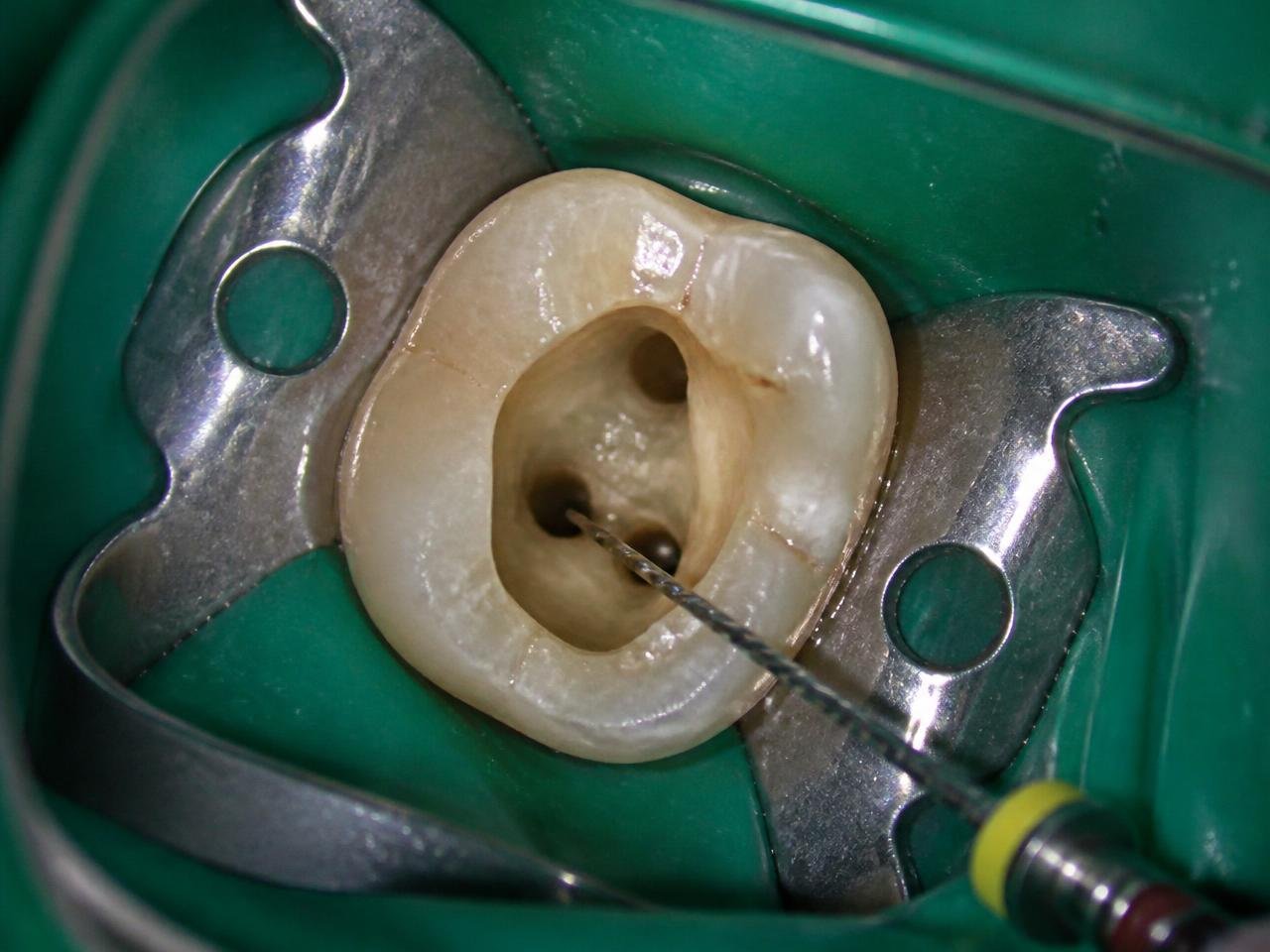 Acesso e localização — referência do curso Endodontia com Magnificação