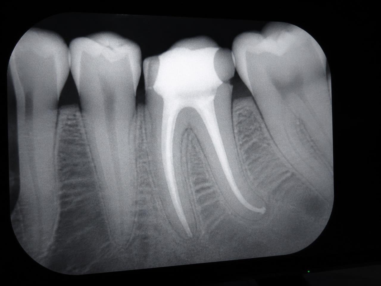 Obturação conferida — referência do curso Endodontia com Magnificação